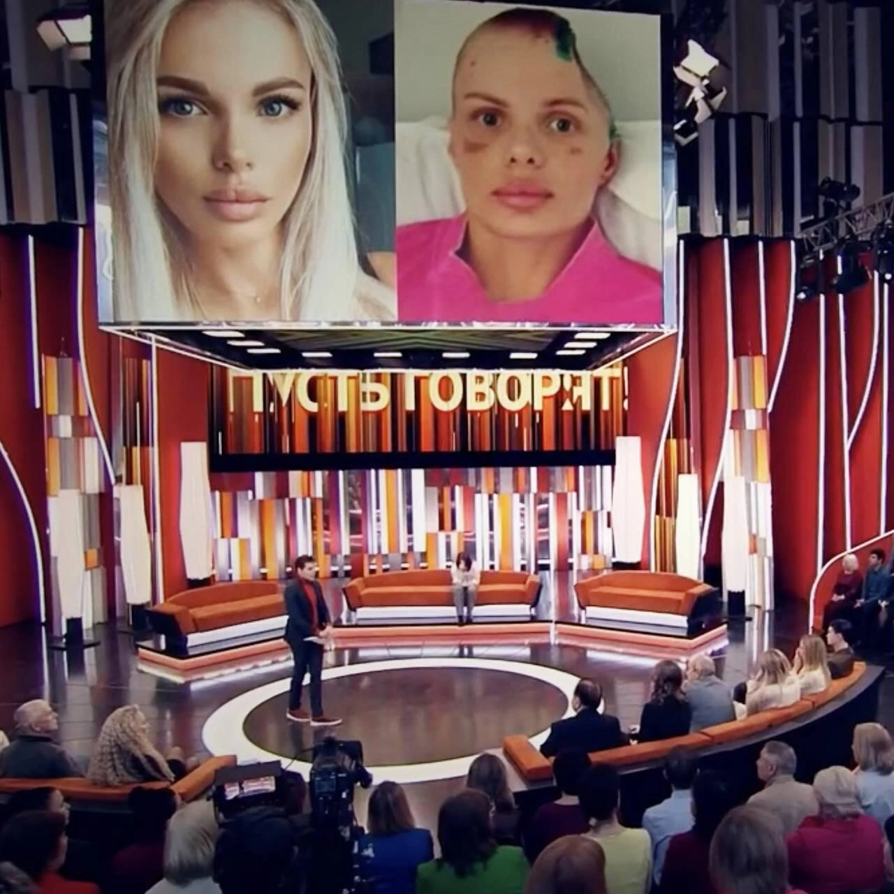 Rus model sevgilisi tərəfindən vəhşicəsinə döyüldü – Kəllə sümüyünün yarısını itirib - (Fotolar)