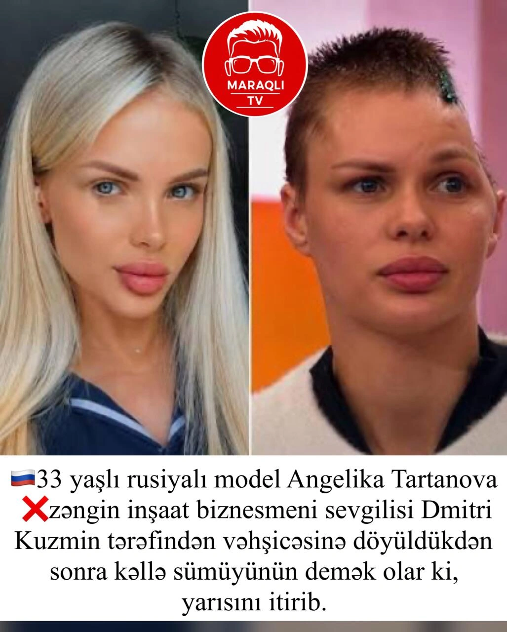 Rus model sevgilisi tərəfindən vəhşicəsinə döyüldü – Kəllə sümüyünün yarısını itirib - (Fotolar)