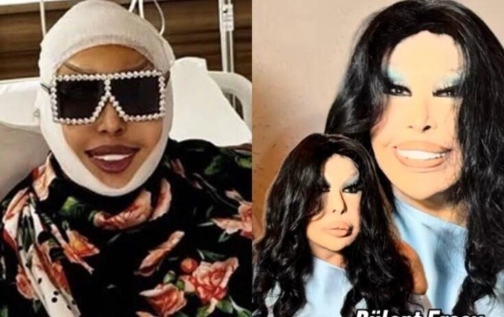 Bülent Ersoy estetik əməliyyatdan sonra (Foto)